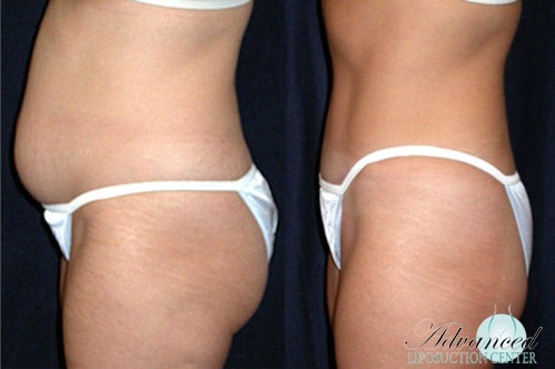 Outer Thighs Liposuction - KleinLipo - Liposuction Surgery of