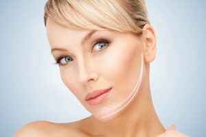 Woman after kybella 3.16.16