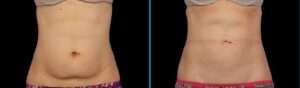 Comparing CoolSculpting to Zerona