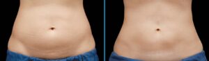 Comparing CoolSculpting to SculpSure