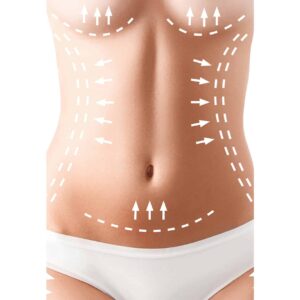 mini tummy tuck