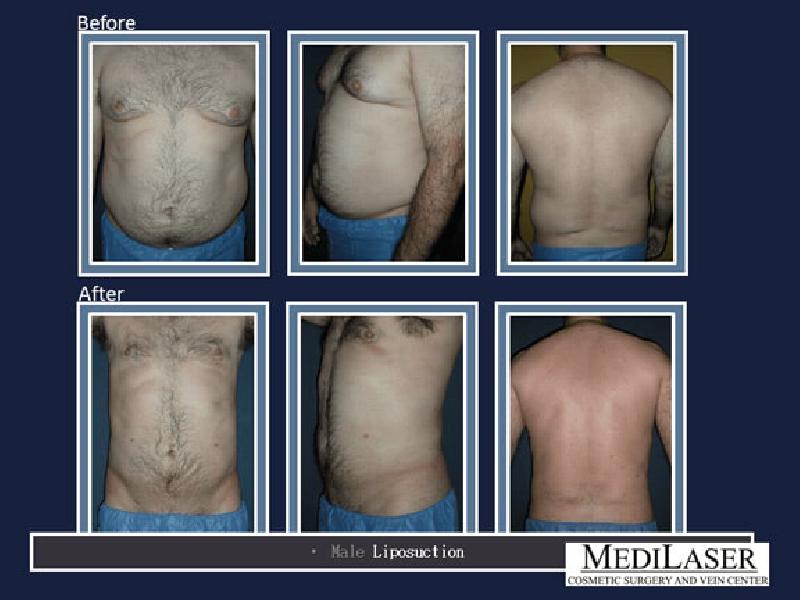 Tummy-Tuck-Ab-Definition-Procedure - Medilaser Surgery and Vein Center