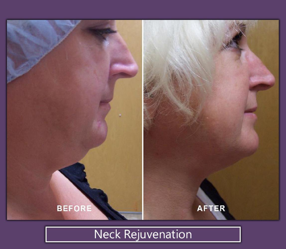 Neck liposuction vs. Kybella® for treatment of submental fullness from fat